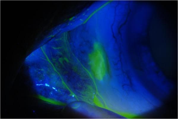 Clinical photograph of an eye under cobalt blue light illumination after fluorescein staining, illustrating conjunctival and scleral pathology. The image displays a focal area of bright green fluorescein uptake, signifying conjunctival erosion and epithelial defect. This irregular, elongated region of fluorescence is located over a section of markedly white, avascular sclera, indicative of scleral thinning or melting. Within the affected zone, small, punctate white spots are visible, consistent with calcium deposits. The surrounding conjunctival tissue appears relatively hypovascular, with visible but sparse perilimbal vessels. This finding is clinically relevant in the context of necrotizing scleritis or surgically induced scleral necrosis (SINS), demonstrating the loss of tissue integrity and the characteristic 'melting' appearance associated with chronic inflammation or ischemia of the ocular surface.