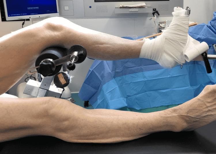 A clinical procedural photograph demonstrating the intraoperative positioning of a patient's lower extremities for orthopedic surgery, specifically a distal femur fracture reduction. The patient is in a supine position on a radiolucent traction table. The left leg is flexed at the knee and supported by a specialized tibia nailing attachment featuring a black cylindrical femoral condyle pad to provide posterior support. The left foot is meticulously wrapped in white orthopedic wool and secured to a mechanical traction unit footplate using adhesive bandages and clamps to maintain longitudinal traction and rotational control. The right leg remains in a neutral, extended position on the surgical table. Visible hardware includes metallic support rods, adjustable knobs for precise limb alignment, and blue surgical drapes in the background. This setup illustrates the 'indirect reduction' technique required for intramedullary nailing or internal fixation of distal femoral fractures, allowing for fluoroscopic imaging and limb manipulation.