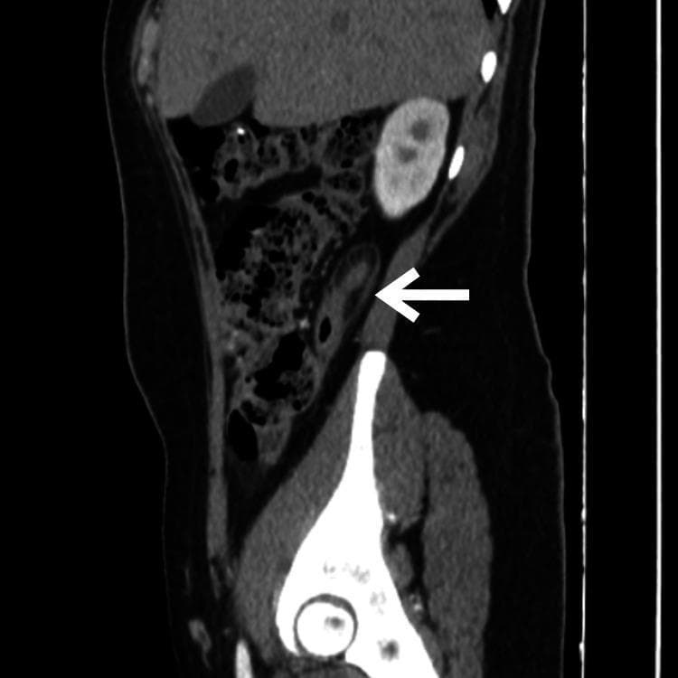 This diagnostic image is a contrast-enhanced computerized tomography (CT) scan of the abdomen and pelvis in a sagittal view. A white arrow points to a dilated and thickened vermiform appendix located in a retrocecal position. The primary visible pathology is appendiceal dilation and wall thickening, which are hallmark radiological signs of acute appendicitis. Additionally, the scan demonstrates subtle increased attenuation and striation within the periappendicular fat, representing inflammatory stranding. Anatomical landmarks include the kidney, liver, and pelvic bones, providing orientation for the right lower quadrant pathology. This image is used as an educational resource to illustrate the diagnostic imaging criteria for appendicitis, specifically emphasizing how sagittal reconstructions help visualize the longitudinal course and surrounding tissue changes of the appendix in complex or retrocecal presentations.