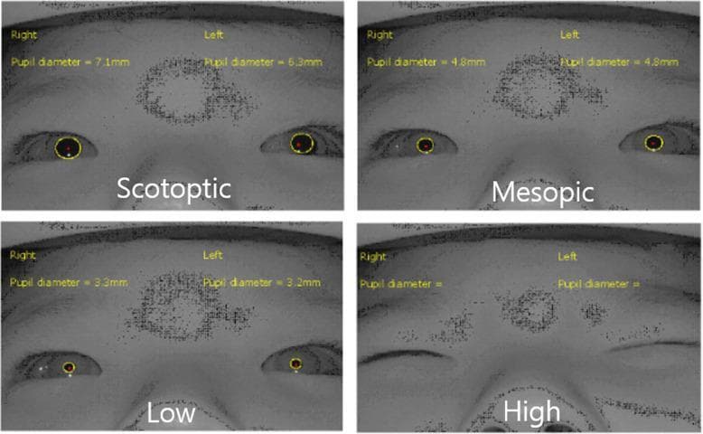 This clinical comparison chart presents four near-infrared snapshots of a patient's eyes across different light intensities (Scotopic, Mesopic, Low, and High) to assess pupil dynamics and reflexive eye closure. The scotopic phase shows maximal dilation with pupil diameters of 7.1mm (right) and 6.3mm (left). The mesopic and low-intensity phases demonstrate progressive pupillary constriction (4.8mm and ~3.2mm respectively) with maintained eyelid aperture. In the high-intensity phase (100 cd/m2), total reflexive eye closure (TEC) is observed, obscuring the pupils entirely. Each image features automated pupillometry tracking with yellow contours outlining the pupils and red central markers. The visual material is representative of neuro-ophthalmological monitoring of photosensitivity and the pupillary light reflex. The images were captured using a vision monitoring system specifically designed for real-time assessment of eyelid position and pupil diameter in varying luminance environments.