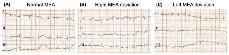 This diagnostic image displays a three-panel comparison of electrocardiogram (ECG) tracings illustrating Mean Electrical Axis (MEA) deviations in a small mammal model (O. degus). Each panel (A, B, C) presents standard bipolar leads I, II, and III on a red-grid background with a calibration of 50 mm/s and 20 mm/mV. (A) Normal MEA: Shows predominantly positive QRS complexes across leads I, II, and III, indicating a balanced electrical vector. (B) Right MEA Deviation: Characterized by a predominantly negative or smaller amplitude QRS deflection in lead I and a prominent positive deflection in lead III, signifying a rightward shift. (C) Left MEA Deviation: Demonstrates a strongly positive QRS deflection in lead I paired with a negative or small amplitude deflection in lead III, indicating a leftward shift. The tracings provide a visual reference for vector analysis and the diagnosis of cardiac axis shifts, highlighting morphology changes in the QRS complex, P waves, and T waves relevant to veterinary and comparative cardiology.