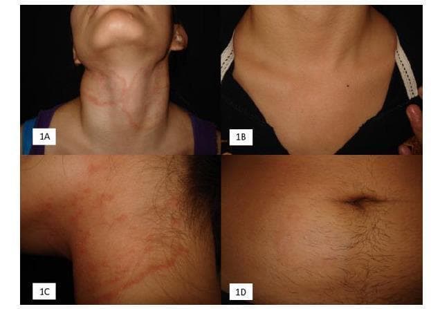This composite of clinical photographs illustrates the presentation and treatment response of Tinea gladiatorum (tinea corporis), a fungal infection common in contact sports. Panel 1A shows extensive, erythematous, annular plaques with raised borders on the neck and upper chest, demonstrating the characteristic ‘ringworm’ morphology. Panel 1B presents the same patient post-treatment, showing near-complete clinical resolution with minimal residual hyperpigmentation. Panel 1C provides a close-up view of the inflammatory lesions, highlighting the irregular, serpiginous, and papular nature of the raised border. Panel 1D displays a different clinical manifestation on the abdomen: a subtle, hypochromic plaque with fine peripheral desquamation (scaling), representing a localized fungal infection. These images are educational for dermatology and sports medicine, emphasizing the varied clinical appearances of Trichophyton tonsurans infections—from highly inflammatory disseminated lesions to more subtle, scaly plaques—and the efficacy of antifungal therapy.