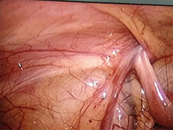This laparoscopic diagnostic image depicts a view of the internal abdominal cavity, specifically focusing on the pelvic anatomy near the inguinal region. The primary visual element is the oviduct (fallopian tube), which is seen extending into an unclosed internal inguinal canal orifice, characteristic of an indirect inguinal hernia or incarcerated adnexa. The oviduct appears tubular, slightly thickened, and exhibits signs of mild edema and hyperaemia, evidenced by a swollen morphology and a reddish-pink hue due to increased vascularity. The surrounding parietal peritoneum shows a prominent network of small, congested blood vessels. Key anatomical landmarks visible include the internal ring of the inguinal canal and the adjacent abdominal wall lining. This image serves as an educational tool for identifying adnexal involvement in pediatric or adult female inguinal hernias and demonstrates the visual manifestations of early inflammatory changes (edema and hyperemia) in incarcerated tissue during laparoscopic exploration.