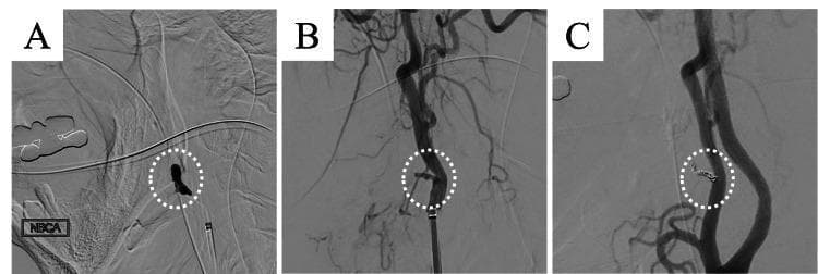 This set of three digital subtraction angiography (DSA) images (A, B, and C) documents the endovascular management of massive oropharyngeal hemorrhage involving the right facial artery. Panel A demonstrates a selective catheterization of the facial artery, where a liquid embolic agent, n-butyl cyanoacrylate (NBCA) mixed with Lipiodol, is being administered. The NBCA-Lipiodol mixture appears as a radiopaque, irregular cast (circled) within the arterial lumen. Panel B shows a follow-up external carotid angiography, revealing the resulting 'blind end' or abrupt truncation of the facial artery proximal to the embolization site, indicating successful initial occlusion. Panel C illustrates the final procedural stage with the placement of secondary metallic embolic coils (circled) at the same arterial segment to reinforce the occlusion and ensure definitive hemostasis. The sequence illustrates a multimodal endovascular approach (liquid embolic combined with coils) to manage high-flow arterial bleeding associated with head and neck pathology, specifically targeting branches of the external carotid artery system.
