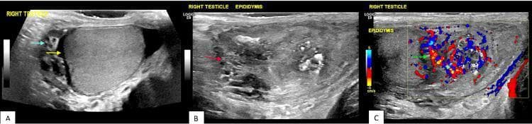 Diagnostic scrotal ultrasound montage consisting of grayscale and color Doppler images illustrating acute epididymo-orchitis. Panel A (grayscale) displays the right testicle accompanied by a small reactive hydrocele; the fluid collection contains low-level internal echoes (proteinaceous material) and thin septations/separations. Panel B (grayscale) focuses on the right epididymis, which appears significantly swollen, edematous, and heterogeneous in texture compared to normal anatomy. Panel C (color Doppler) demonstrates marked hyperemia within the enlarged epididymis, characterized by increased red and blue flow signals indicating high vascularity. These findings are pathognomonic for an inflammatory or infectious process of the scrotum, such as epididymitis with secondary orchitis and a complex reactive hydrocele. Key features include epididymal enlargement, altered echogenicity, increased blood flow (hyperemia), and septated fluid collections within the tunica vaginalis.