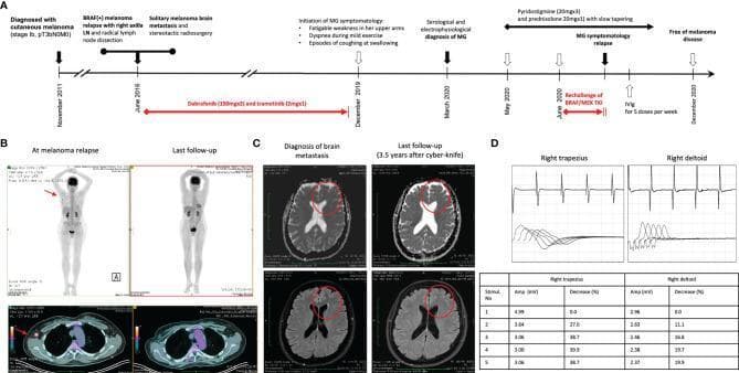 A multi-panel medical figure documenting a clinical case of metastatic melanoma and secondary myasthenia gravis (MG). Panel A presents a longitudinal timeline (2011โ2020) tracking cutaneous melanoma diagnosis, BRAF(+) relapse, brain metastasis, and the subsequent onset of MG during targeted therapy with BRAF/MEK inhibitors (dabrafenib/trametinib). Panel B contains whole-body PET/CT scans and axial CT slices; the 'At melanoma relapse' images show a hypermetabolic focus in the right axilla (indicated by red arrows), which resolves at 'Last follow-up'. Panel C displays axial brain MRI slices (T1 and FLAIR) showing a solitary left frontal lobe metastasis at diagnosis, with subsequent volume reduction and scarring observed 3.5 years post-stereotactic radiosurgery (Cyber-knife). Panel D illustrates neurophysiological diagnostics for MG, including repetitive nerve stimulation (RNS) waveforms from the right trapezius and deltoid muscles. The accompanying table quantifies a pathological decrement in compound muscle action potential (CMAP) amplitude (up to 39.9%), diagnostic of a neuromuscular junction disorder.