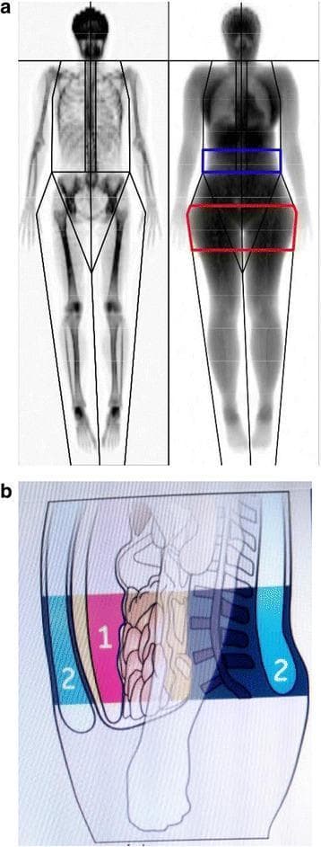 This dual-panel image demonstrates body composition analysis using Dual-Energy X-ray Absorptiometry (DEXA). Figure 1a displays two total-body DEXA scans illustrating different phenotypes: a lean individual on the left with high bone-to-soft-tissue contrast, and an individual with higher fat mass on the right where soft tissue obscuration reduces bone clarity. Color-coded Regions of Interest (ROI) are highlighted on the right-hand figure: a blue rectangular box designates the android region (abdominal/L1–L4 area), and a red trapezoidal box indicates the gynoid region (hip and upper thigh area). Figure 1b provides a cross-sectional anatomical diagram of the android region to differentiate adipose tissue compartments. It distinguishes visceral adipose tissue (labeled 1), depicted as pink internal masses located deep within the abdominal cavity near the viscera and spine, from subcutaneous adipose tissue (labeled 2), shown as a peripheral blue/yellow layer situated immediately beneath the skin. This visual illustrates clinical methods for assessing regional fat distribution and metabolic risk markers like VAT in patients with conditions such as COPD or obesity.