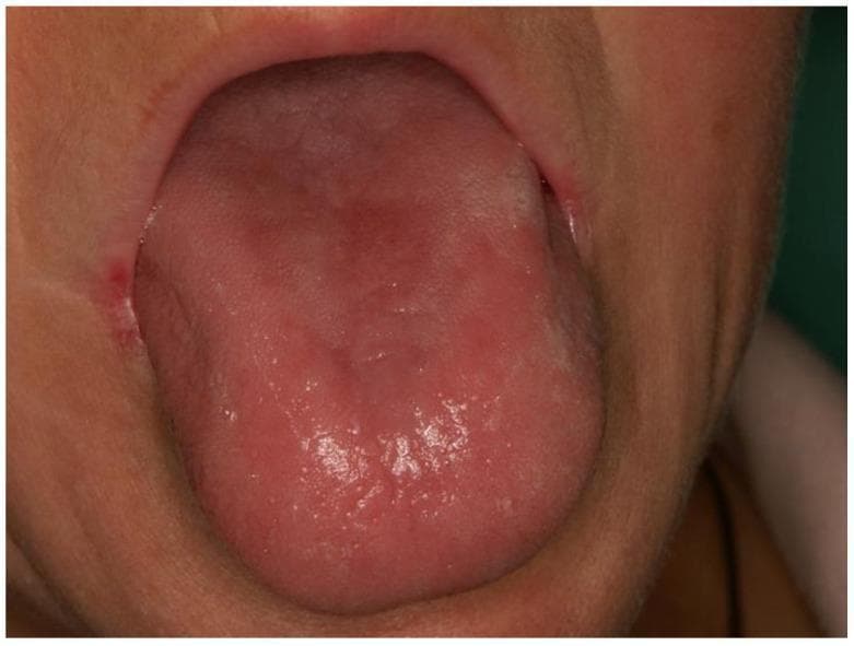This clinical photograph shows intraoral manifestations of vitamin deficiency, specifically exfoliative glossitis and angular cheilitis associated with hypovitaminosis of B-group vitamins (B2 and B6). The tongue exhibits a diffuse, erythematous (reddish) appearance with a predominantly smooth, depapillated surface, characteristic of atrophic glossitis. Patchy areas of irregular texture and mucosal thinning are visible across the dorsal surface. At the left labial commissure (corner of the mouth), there is evident redness, inflammation, and superficial skin breakdown consistent with angular cheilitis. These findings are clinical markers for nutritional deficiencies, often presenting with burning sensations in the oral mucosa. The image serves as an educational example of the systemic relationship between water-soluble vitamin status and soft tissue oral health, highlighting diagnostic signs that may be encountered in pediatric or malnourished populations.