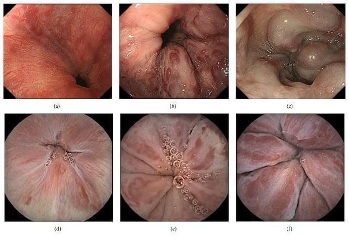 A multi-panel clinical diagnostic image comparing Esophagogastroduodenoscopy (EGD) and Capsule Endoscopy (CE) in the evaluation of esophageal varices (EVs). The top row (a-c) displays EGD views showing the progressive classification of varices by form: (a) Stage F1 presenting as straight, small-caliber longitudinal vessels; (b) Stage F2 showing moderately enlarged, beady or tortuous varices; and (c) Stage F3 showing markedly enlarged, nodular, or tumor-shaped varices that obstruct the esophageal lumen. The bottom row (d-f) provides corresponding circular-frame CE images of the same stages. The CE images demonstrate a wider field of view but varied resolution compared to conventional endoscopy. Key educational features include the visualization of red color signs (RC signs) such as red wale marks and cherry red spots, which are critical indicators of hemorrhage risk in portal hypertension. This comparison serves as a clinical reference for assessing the diagnostic accuracy and morphological presentation of esophageal varices across different endoscopic modalities.