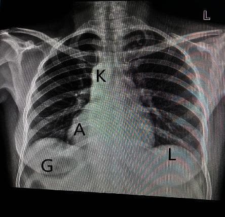 A posteroanterior (PA) chest X-ray demonstrating situs inversus totalis, a congenital condition where the major visceral organs are reversed from their normal positions. The imaging modality clearly shows dextrocardia, with the cardiac apex (A) and the aortic knuckle (K) situated in the right hemithorax. In the subdiaphragmatic region, there is a complete transposition of abdominal viscera: the gastric bubble (G) is located in the right upper quadrant, while the radiopaque liver shadow (L) is positioned in the left upper quadrant. The anatomical landmarks are labeled to highlight this mirror-image arrangement relative to typical human anatomy. This diagnostic image is intended for medical education regarding congenital anomalies, radiological identification of situs syndromes, and clinical interpretation of chest radiographs in patients with dextrocardia.