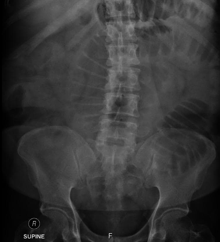 This diagnostic image is a plain abdominal radiograph (X-ray) in the supine position. The primary findings are multiple dilated loops of small bowel located centrally within the abdomen. Distinctive horizontal air-fluid levels are visible within these dilated segments, a hallmark radiological sign of mechanical bowel obstruction or ileus. The valvulae conniventes (circular folds) are evident across the full width of the dilated loops, identifying them as small intestine rather than large bowel. There is a notable absence of significant gas within the distal colon and rectum, further supporting the diagnosis of a high-grade small bowel obstruction. Bony structures, including the lumbar spine and pelvis, appear unremarkable in this view. This image serves as a classic educational example of the radiographic presentation of small bowel obstruction, demonstrating the 'stepladder' appearance often seen when multiple air-fluid levels are present in various loops.