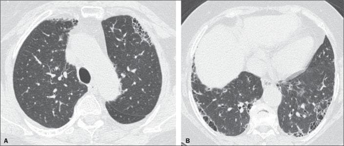 High-resolution computed tomography (HRCT) of the chest in axial views (A and B) demonstrating a typical Usual Interstitial Pneumonia (UIP) pattern. Image A (upper level) and Image B (lower level) reveal characteristic features of fibrosing interstitial lung disease. Key findings include prominent subpleural honeycombing, characterized by clustered, thick-walled cystic airspaces measuring 3-10 mm in diameter. These are associated with reticular opacities and architectural distortion. The distribution is classically peripheral and basilar-predominant, with Image B showing more extensive involvement of the lower lobes compared to the upper zones in Image A. Traction bronchiectasis and subtle ground-glass opacities are also visible within the areas of fibrosis. This pattern is consistent with a multidisciplinary diagnosis of UIP, which in this case is associated with rheumatoid arthritis-related interstitial lung disease.