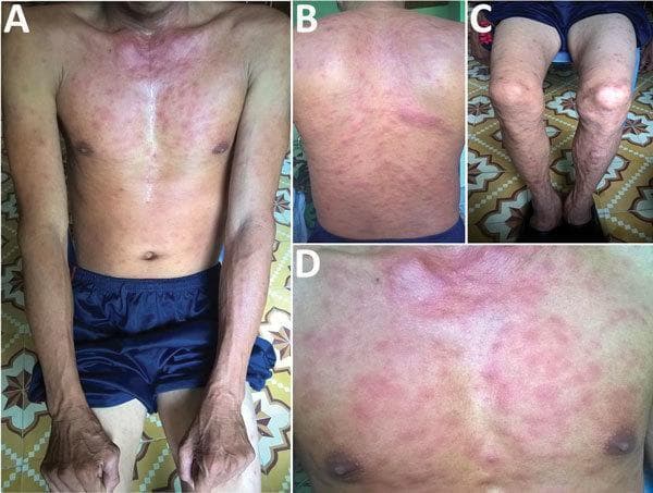 This composite clinical photograph displays a 35-year-old male patient presenting with a generalized maculopapular rash secondary to scrub typhus (Orientia tsutsugamushi infection). The four panels (A-D) illustrate the distribution across different anatomical regions: (A) anterior trunk and arms, (B) back, (C) lower legs, and (D) a close-up of the chest. The rash is characterized by numerous erythematous macules and small papules. The density is highest on the trunk and chest, where lesions show a confluent, intensely red appearance, particularly around the upper chest and neck. On the back and extremities, the rash appears more discrete and sparse, with individual lesions showing clearer margins against unaffected skin. This presentation is a classic dermatological manifestation of rickettsial diseases, typically appearing several days after the onset of fever. The visual findings assist in the clinical diagnosis of scrub typhus in endemic regions, often found in conjunction with a pathognomonic eschar at the mite bite site.