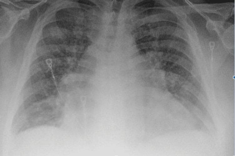This anterior-posterior (AP) chest X-ray illustrates classic radiological findings of acute congestive heart failure. The primary finding is significant cardiomegaly, with the cardiac silhouette appearing enlarged and globular, occupying more than 50% of the thoracic diameter. Diffuse, bilateral hazy opacities are present throughout both lung fields, consistent with pulmonary edema. These opacifications are most prominent in the perihilar regions and lung bases, obscuring normal pulmonary vasculature and the sharp definition of the diaphragmatic borders. The costophrenic angles appear blunted, suggesting associated pleural effusions. Visible medical hardware includes ECG leads positioned on the chest wall. The image serves as an educational example of how chronic heart failure with reduced ejection fraction manifests as pulmonary venous congestion and interstitial-to-alveolar edema on diagnostic imaging.
