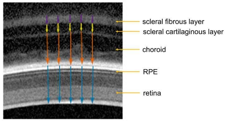 This diagnostic image is a B-scan Optical Coherence Tomography (OCT) cross-section of a fundus, specifically illustrating the anatomical stratification of the ocular posterior segment. The image demonstrates five distinct layers from inner to outer (bottom to top in this orientation): the retina, the retinal pigment epithelium (RPE), the choroid, the scleral cartilaginous layer, and the scleral fibrous layer. Annotated color-coded arrows indicate thickness measurements for each layer: blue for retina (from the inner limiting membrane to the RPE), orange for choroid (extending from the hyperreflective RPE to the sclera), yellow for the scleral cartilaginous layer, and purple for the outermost scleral fibrous layer. Visually, the retinal and choroidal layers exhibit higher signal intensity and structural detail, while the scleral layers appear as more homogenous, hyporeflective bands. This visual resource is intended for ophthalmology education to teach the diagnostic identification of fundal layers and the methodology for quantifying layer-specific biometric changes in ophthalmic research.
