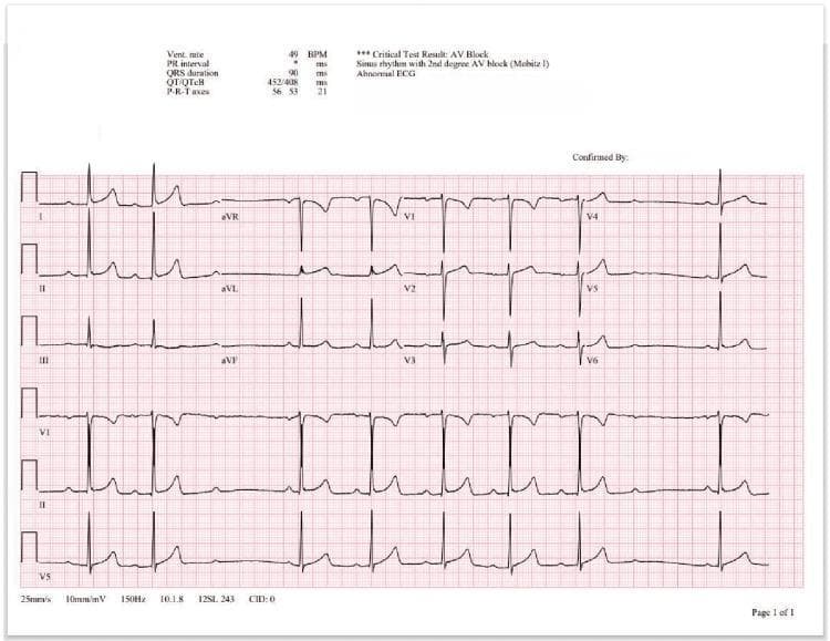 A standard 12-lead electrocardiogram (ECG) presented on a red-grid background, displaying leads I, II, III, aVR, aVL, aVF, and V1–V6. The ECG illustrates a classic Second-Degree Atrioventricular (AV) Block, specifically Mobitz Type I (Wenckebach phenomenon). The visual hallmark demonstrated is the progressive lengthening of the PR interval in successive beats until a P-wave is blocked and fails to conduct, resulting in a dropped QRS complex. The automated interpretation header identifies a bradycardic ventricular rate of 49 BPM, a QRS duration of 90 ms, and a diagnosis of sinus rhythm with Mobitz I AV block. The tracing shows normal QRS and T-wave morphology. Technical specifications noted at the footer include a paper speed of 25 mm/s, voltage calibration of 10 mm/mV, and a 150 Hz filter. This visual serves as a primary educational example for differentiating types of AV nodal conduction delays and recognizing non-linear cardiac rhythms.