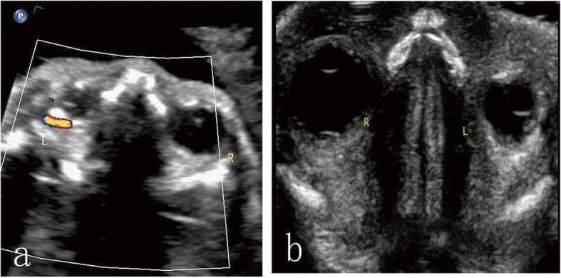 Two-panel prenatal diagnostic ultrasound images of a fetus at 24 weeks gestation in the transverse plane, illustrating orbital asymmetry and retro-orbital pathology. Panel (a) utilizes Color Doppler imaging, showing distinct red and blue flow signals indicative of angiogenesis within a lesion in the left retro-orbital space. The left eye globe (L) is notably smaller than the right eye globe (R), supporting a diagnosis of microphthalmia. Panel (b) employs high-frequency grayscale ultrasound, revealing a crescent-shaped hyperechoic band in the left retro-orbital space. The comparison clearly demonstrates the size discrepancy between the normal right orbit and the microphthalmic left orbit. Key educational concepts include the identification of fetal ocular abnormalities, the use of Doppler to assess tumor vascularity, and the recognition of retro-orbital masses (later histopathologically confirmed as orbital teratoma) in a prenatal setting. The images highlight the diagnostic pathway for fetal orbital lesions by combining morphological assessment with vascular characterization.