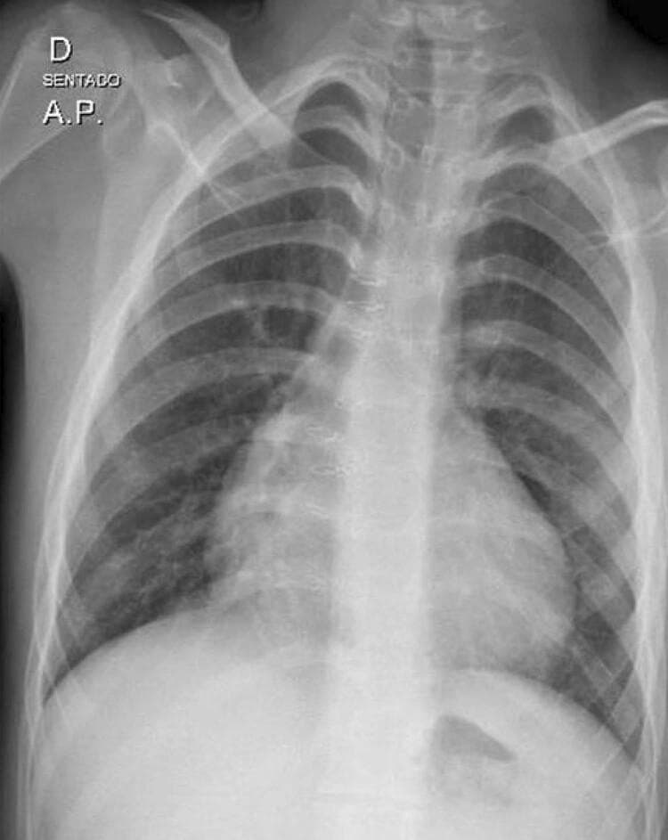 This diagnostic image is an anteroposterior (AP) chest radiograph showing moderate cardiomegaly in a human patient. The cardiac silhouette is enlarged with a cardiothoracic ratio of approximately 0.60, primarily involving the right-sided cardiac chambers as evidenced by the prominence of the atrial and ventricular arches. Notable clinical features include a widened mediastinal contour and progressive cardiac enlargement post-surgical correction. Despite the increased cardiac area, the pulmonary vascular markings appear within normal limits, showing no clear signs of pulmonary venous congestion or edema. The bony structures of the rib cage, the trachea, and the diaphragmatic contours are visible and appear structurally intact. This x-ray is a key educational example of postoperative cardiac monitoring and the visual manifestation of selective chamber enlargement in cardiovascular pathology.