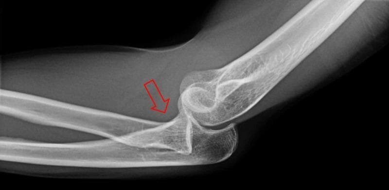 This diagnostic image is a lateral X-ray radiograph of the elbow joint. It demonstrates significant musculoskeletal pathology involving the proximal forearm and distal humerus. The primary finding is a radial head dislocation, where the radial head is displaced anteriorly and is no longer articulating with the capitellum of the humerus. This misalignment is indicated by a red arrow pointing toward the displaced radial head. Additionally, the image shows signs of elbow subluxation, characterized by an incongruous relationship between the trochlear notch of the ulna and the trochlea of the humerus, suggesting partial loss of contact between the joint surfaces. Key anatomical landmarks visible include the distal humeral epicondyles, the olecranon process, and the coronoid process of the ulna. There is no evidence of an acute fracture in this projection. This radiographic study is clinically significant for diagnosing complex elbow injuries and assessing the need for orthopedic reduction. It serves as an educational example of traumatic joint disruption for students and clinicians in emergency medicine and orthopedics.