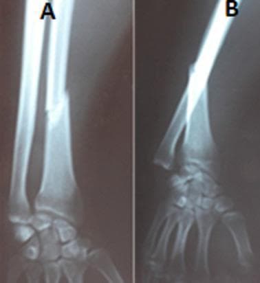 This diagnostic image consists of two radiographic views (X-rays) of the forearm and wrist: an anteroposterior (AP) view (A) and a lateral view (B). The images demonstrate a Galeazzi fracture-dislocation. In view A, a clear transverse-to-oblique fracture of the radial shaft is visible at the junction of the middle and distal thirds, accompanied by shortening and radial angulation. View B highlights the associated disruption of the distal radioulnar joint (DRUJ), showing a prominent dorsal dislocation of the ulnar head relative to the radius and carpus. This combination of a distal radius fracture and DRUJ instability is a hallmark of the Galeazzi injury pattern. The content is clinically categorized as a Mansat stage III fracture-dislocation, indicating significant ligamentous and bony disruption. This material is suitable for orthopedic education regarding forearm trauma, illustrating the mechanical relationship between long bone fractures and adjacent joint stability.