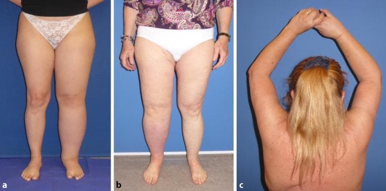 This composite clinical photograph displays three examples of lymphedema, a condition characterized by impaired lymphatic drainage and resultant tissue swelling. Panel A illustrates idiopathic primary lymphedema in the left lower extremity of a 19-year-old female; the affected leg shows significant circumferential enlargement and loss of normal anatomical contours, particularly around the ankle and calf. Panel B shows secondary lymphedema in the right lower extremity of a 62-year-old female following uterine cancer treatment and lymph node dissection. This limb exhibits marked edema and distinctive reddish-purple skin discoloration (erythema) on the lower leg, suggesting chronic inflammatory changes or circulatory stasis. Panel C shows secondary lymphedema in the right upper extremity of a 58-year-old female following mastectomy and axillary lymph node dissection. The right arm demonstrates increased girth compared to the left, visible from the posterior view with arms elevated. These images serve as educational examples of both primary (idiopathic) and secondary (iatrogenic/cancer-related) lymphedema, highlighting characteristic asymmetric swelling and associated skin changes.