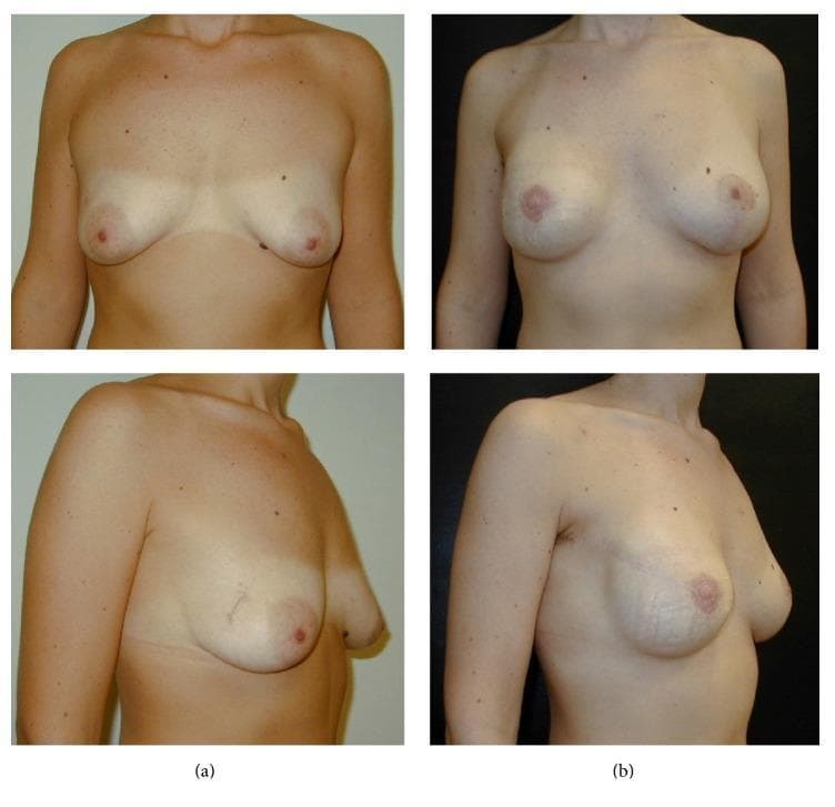 Clinical photographs showing preoperative (a) and postoperative (b) views of a patient undergoing oncoplastic breast surgery. Panel (a) illustrates the baseline anatomy with moderate breast volume and natural ptosis. Panel (b) demonstrates the results of a right-sided nipple-sparing mastectomy (NSM) with a radial lateral incision and immediate one-stage implant-based reconstruction. Simultaneously, the left breast shows the outcome of augmentation mastopexy performed via periareolar incision with a vertical extension to achieve symmetry. Visually, the postoperative state shows increased upper pole fullness, improved projection, and corrected ptosis. Subtle surgical scarring is visible on the lateral aspect of the right breast and the periareolar/vertical regions of the left breast. These images serve as an educational example of complex oncologic reconstruction combined with contralateral symmetrization in plastic and reconstructive surgery.