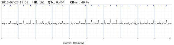 This diagnostic image shows a 10-second single-lead electrocardiogram (ECG) recording obtained from a handheld device, demonstrating a clinical case of atrial fibrillation (AF). The waveform displays a tachycardic, irregularly irregular rhythm with a high frequency of QRS complexes. Key automated measurements visible at the top of the strip include a heart rate (HR) of 161 beats per minute, a corrected QT interval (QTc) of 0.464, and an RR variability (RRvar) of 49%. The baseline lacks distinct, organized P waves, replaced instead by irregular fibrillatory activity. The ECG is presented on a standard grid with a paper speed of 25 mm/s and a sensitivity of 10 mm/mV. This visual serves as an educational example of how portable rhythm monitoring technology can identify paroxysmal or persistent atrial fibrillation in a community or home-based clinical setting.