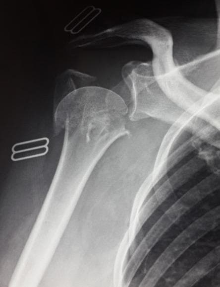 Anteroposterior (AP) radiograph of the right shoulder demonstrating a complex, comminuted proximal humerus fracture in an adult patient. According to the Neer classification system, this appears to be a 4-part fracture involving the surgical neck, the anatomical neck, and the greater tuberosity. Significant cortical disruption is visible, with multiple distinct bone fragments exhibiting displacement and angulation relative to the humeral shaft. The articular surface of the humeral head shows signs of involvement and spatial malalignment within the glenohumeral joint. There is also a visual suggestion of displacement of the greater tuberosity fragment. Radiopaque surgical clips are present in the soft tissues lateral to the humerus, likely from a previous or concurrent surgical procedure. The imaging is consistent with high-energy trauma or osteoporotic fragility fracture, illustrating the pedagogical challenge of identifying specific fracture lines in cases of severe comminution and overlapping fragments.