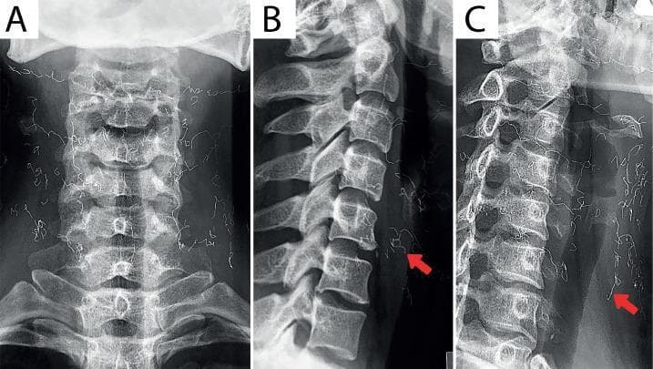 This composite diagnostic image presents three radiographic views of the cervical spine: (A) Anteroposterior (AP), (B) Lateral, and (C) Oblique. The lateral view demonstrates a significant loss of the normal cervical lordosis, indicative of straightening of the spine. Degenerative changes are visible, including reduced intervertebral disc space height at the C4-C5 level and marginal osteophytes at the C5-C7 vertebrae. Most notably, all three views reveal multiple, thin, radiopaque string-like foreign materials (indicated by red arrows in B and C) distributed in a mesh-like pattern over the anterior and bilateral soft tissues of the neck. These findings are characteristic of cosmetic gold thread implantation (gold thread lift). The image is relevant for radiology and musculoskeletal educational indexing, illustrating both degenerative spondylosis and the radiographic appearance of subcutaneous cosmetic implants.