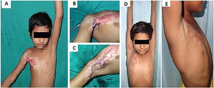 This clinical series documents the surgical management of a pediatric post-burn axillary contracture using a square flap and transposition flaps. Image A shows the preoperative state with a severe Type 1a contracture of the right anterior axillary fold, characterized by hypertrophic scarring, skin tethering, and significantly limited shoulder abduction. Image B displays the intraoperative preoperative markings for a square flap and two adjacent triangular flaps designed to release the tension. Image C illustrates the immediate postoperative result, showing the advancement of the square flap and transposition of the triangular flaps secured with sutures, effectively lengthening the axillary fold. Images D and E show the one-year follow-up results in frontal and lateral views, demonstrating successful scar remodeling and the restoration of full, 180-degree shoulder abduction. The series highlights surgical techniques in plastic and reconstructive surgery for burn sequelae, focusing on contracture release and regional flap design to improve functional and cosmetic outcomes.
