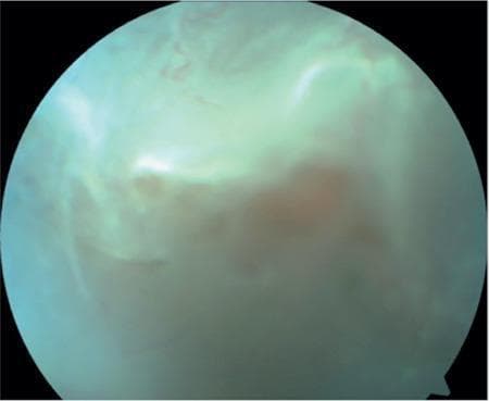 This clinical diagnostic image is a preoperative fundus photograph of the left eye in a patient with Stickler syndrome. The image demonstrates a rhegmatogenous retinal detachment associated with Grade C2 proliferative vitreoretinopathy (PVR). The retinal surface exhibits a hazy, mottled texture with a characteristic bluish-green hue and increased reflectivity, particularly in the superior quadrants, indicative of retinal folds and subretinal fluid accumulation. There is a notable lack of distinct retinal vasculature due to the significant vitreous opacity and membranous changes in the periphery. A central reddish-brown area is visible, suggesting a region of significant retinal thinning or a retinal hole that allows for visualization of the underlying choroidal pigment. The overall appearance captures the chronic nature of the detachment with irregular contours and evidence of contractile PVR membranes that distort the normal anatomical landmarks of the posterior pole.