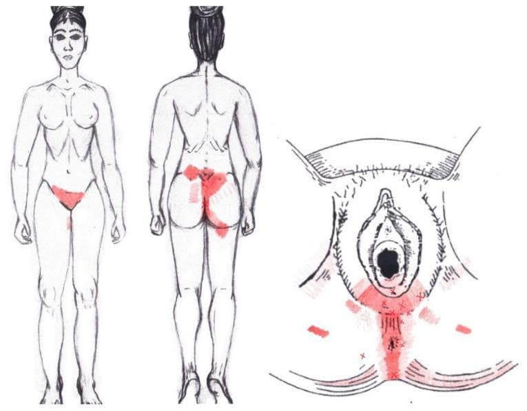 This medical illustration presents a graphical simulation of referred pain patterns associated with the coccygeus muscle in a female anatomical model. The visual includes three components: a full-body anterior view, a full-body posterior view, and a localized perineal diagram. Referred pain zones are indicated by red shading and 'X' markers, with color intensity reflecting the frequency of pain reported in clinical studies. On the anterior view, pain is primarily localized to the pubic and lower hypogastric regions. The posterior view demonstrates significant referred pain across the sacral region, gluteal area (buttocks), and extending toward the upper posterior thighs. The detailed perineal diagram shows pain distribution along the midline from the vulva to the anus, with additional lateral involvement near the ischial tuberosities. This educational material is designed for pelvic health education, illustrating how coccygeus muscle dysfunction can manifest as somatic pain in the urogenital and pelvic floor regions.