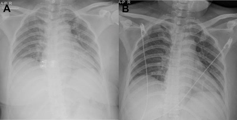 This diagnostic comparison presents two anterior-posterior (AP) chest X-rays (labeled A and B) tracking the progression of pulmonary findings in a patient with dengue hemorrhagic fever (DHF) and iatrogenic fluid overload. Image A shows significant bilateral perihilar haze and increased pulmonary vascular markings, consistent with hilar congestion and early pulmonary edema following aggressive fluid resuscitation. The heart silhouette is visible, and the peripheral lung fields remain relatively clear. Image B, taken after the reduction of intravenous fluids and management toward a negative fluid balance, demonstrates a marked resolution of the bilateral hilar congestion. The central lung fields appear clearer with more distinct bronchial markings. Both images show metallic ECG leads overlying the thorax and a central venous catheter. This comparison illustrates the clinical relevance of radiographic monitoring in managing plasma leakage and fluid therapy in DHF patients to prevent and resolve pulmonary congestion.