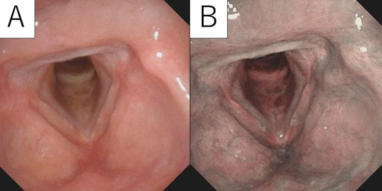 Post-operative clinical endoscopy (laryngoscopy) images comparing the larynx under two different lighting modalities. Image A demonstrates a standard White Light (WL) view, showing pale pink, smooth, and healthy-looking vocal cord mucosa without evidence of residual nodularity or mass lesions. Image B demonstrates the same anatomical region using Narrow-Band Imaging (NBI), which enhances vascular contrast. In the NBI view, the mucosal surface appears darker and more saturated, providing a detailed visualization of the underlying microvascular patterns. Both images confirm the successful surgical excision of a previous laryngeal lesion, likely a cavernous hemangioma, with preservation of normal glottic anatomy and smooth mucosal texture. This comparison is clinically significant for evaluating postoperative recovery and monitoring for potential recurrence by utilizing NBI to detect abnormal neoangiogenesis that might be missed under white light alone.