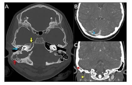 This composite diagnostic image features head computed tomography (CT) scans illustrating complications of Gradenigo's syndrome. Image A is an axial CT scan in a bone window demonstrating complete opacification of the right tympanic cavity (blue arrow) and mastoid air cells (red arrow) with fluid, consistent with acute otomastoiditis. Additionally, there is inflammatory involvement and morphological alteration of the right petrous apex (yellow arrow), indicating petrous apicitis. Images B (axial) and C (coronal) are contrast-enhanced CT scans showing a central filling defect within the right dural venous sinuses. Specifically, there is evidence of acute thrombosis involving the right transverse sinus (blue arrowhead), sigmoid sinus (red arrowhead), and the jugular bulb (yellow arrowhead). This constellation of findings—otomastoiditis, petrous apicitis, and subsequent dural venous sinus thrombosis—highlights the progression of severe middle ear infections into intracranial vascular complications and Gradenigo's syndrome.