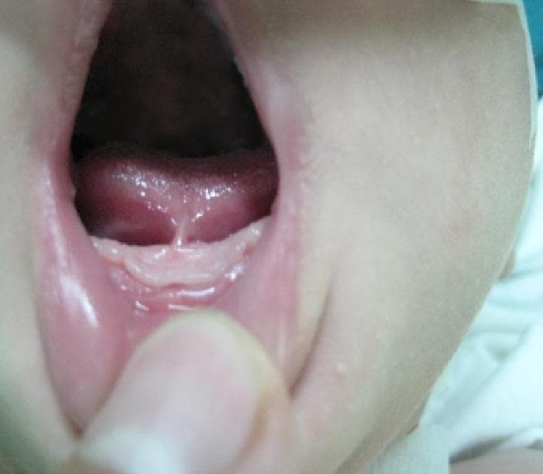 Clinical photograph of an infant's oral cavity illustrating ankyloglossia (tongue-tie). The image shows the ventral surface of the tongue elevated, revealing a short, restrictive lingual frenulum. This fibrous band of tissue attaches the midline of the underside of the tongue close to the mandibular alveolar ridge, limiting the tongue's range of motion. A slight heart-shaped notch or indentation is visible at the tip of the tongue where the frenulum pulls on the muscle. Surrounding oral structures include the lower gingiva, floor of the mouth, and the inner mucosa of the lower lip. This visual is diagnostic for identifying structural causes of breastfeeding difficulties, such as mastalgia in the mother or poor latch in the infant, often necessitating a frenotomy or frenuloplasty. The photograph is categorized under pediatric otolaryngology and intraoral imaging.