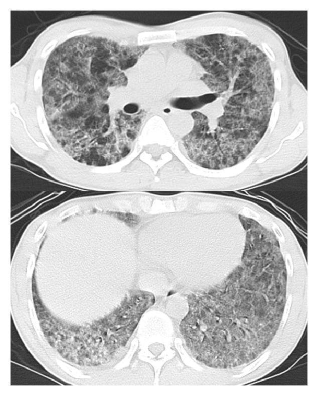 Diagnostic Imaging: This image displays axial slices of a chest computerized tomography (CT) scan in a lung window, representing the upper and lower pulmonary regions. The imaging reveals diffuse, bilateral pulmonary opacities. Key findings include extensive ground-glass opacity (GGO), appearing as a hazy increase in lung density that partially obscures but does not completely hide pulmonary vessels, and areas of airspace consolidation, characterized by denser opacification with obscuration of vascular markings. The distribution is widespread across both lung fields, with consolidation appearing more prominent in the upper lobes. This radiographic pattern is highly suggestive of diffuse alveolar disease, such as atypical pneumonia (e.g., Pneumocystis jirovecii pneumonia), pulmonary edema, or alveolar hemorrhage. It serves as a classic educational example for distinguishing between GGO and consolidation in the context of bilateral diffuse lung infiltration.