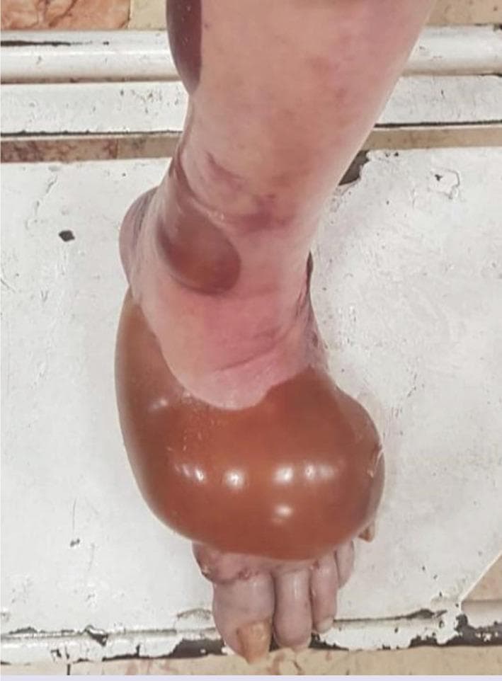 This clinical photograph shows the lower leg and dorsal aspect of the left foot of a 71-year-old patient, demonstrating significant bullous lesions. The primary feature is a large, tense, spherical bulla covering a major portion of the dorsal foot. This lesion is filled with translucent amber or serosanguinous fluid. Secondary, smaller, more irregular bullae with a purplish or hemorrhagic appearance are visible on the lateral and posterior aspect of the distal leg. The surrounding skin exhibits mild erythema and localized edema, particularly at the margins of the largest bulla. The morphology is characteristic of a bullous drug eruption, specifically following methotrexate administration in this clinical context. Educational focus includes the recognition of tense bullae in geriatric patients and the differential diagnosis of drug-induced dermatologic toxicity versus autoimmune blistering diseases like bullous pemphigoid.