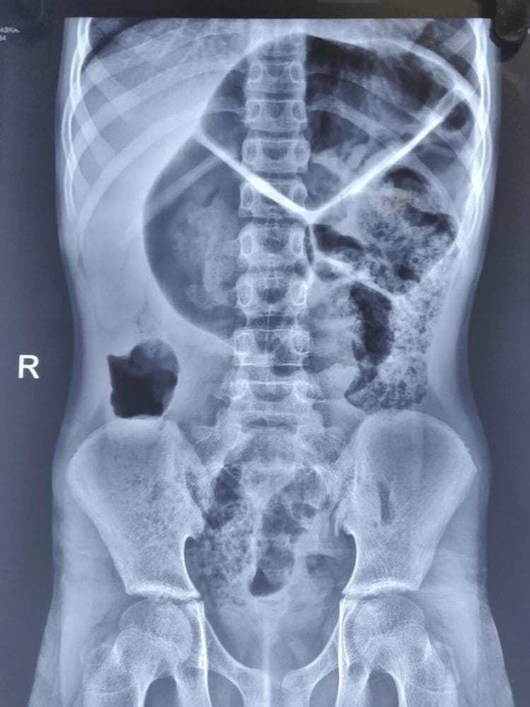 This abdominal erect X-ray (radiography) demonstrates a classic 'Coffee Bean sign,' pathognomonic for sigmoid volvulus. The diagnostic hallmark is a massively dilated colonic loop originating from the pelvis and extending into the upper abdomen, occupying a large portion of the abdominal cavity. The 'coffee bean' appearance is created by the thick inner wall where the two loops of the obstructed bowel meet (the 'crease' of the bean) and the thinner, gas-distended outer walls. The loop shows a lack of haustral markings and a mottled internal texture consistent with a mix of air and fecal matter. Visible secondary features include elevation of the left hemidiaphragm due to increased intra-abdominal pressure and displacement of other abdominal structures. This image serves as a primary educational example for diagnosing large bowel obstruction caused by torsion of the sigmoid colon on its mesentery, often seen in clinical presentations of acute abdominal pain and distension.