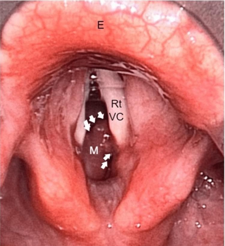 This clinical endoscopic image, obtained during suspension laryngoscopy, demonstrates the anatomical structures of the larynx with a significant obstructive lesion. The epiglottis (E) is visible superiorly, showing normal mucosal vascularity. Below the level of the white, tendinous right vocal cord (Rt VC), a prominent pinkish-red subglottic mass (M) is identified. The mass is lobulated and smooth-surfaced, positioned primarily beneath the right vocal fold. White arrows outline the mass's margins, highlighting its significant intrusion into the laryngeal airway. This encroachment results in substantial luminal narrowing of the subglottic region, clinically representing a high-grade subglottic stenosis. The visual characteristics and location are essential for the differential diagnosis of subglottic lesions, which in this case was histopathologically confirmed as a lobular capillary hemangioma following endoscopic excision. The image serves as an educational tool for otorhinolaryngology, illustrating airway assessment and the endoscopic presentation of laryngeal pathology causing biphasic stridor.