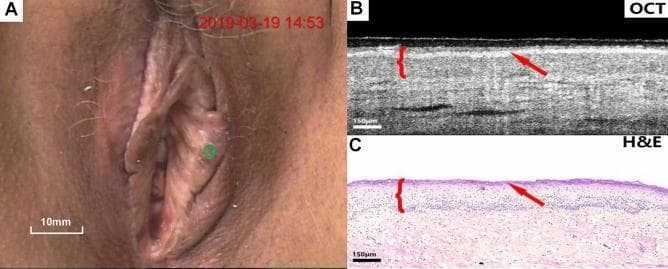A three-panel figure demonstrating clinical and histological features of lichen sclerosus of the vulva. Panel A is a clinical colposcopy photograph showing the macroscopic appearance of the vulvar region, with a green circle indicating the specific site of interest. Panel B is a cross-sectional optical coherence tomography (OCT) image of the affected tissue. It shows well-defined stratification between the epithelium and stroma with uniform optical scattering. A key diagnostic feature highlighted is the loss of the serrated rete peg architecture at the epithelial-stromal junction. A red arrow indicates a hyper-reflective surface layer corresponding to hyperkeratosis, and a red bracket denotes the epithelial thickness. Panel C is a corresponding hematoxylin and eosin (H&E) stained histological section (150 μm scale) that correlates with the OCT findings. It confirms the presence of surface keratinization (arrow), a thinned or flattened epithelial layer (bracket), and the absence of rete pegs, consistent with lichen sclerosus pathology. This comparison serves as a diagnostic reference for utilizing non-invasive OCT imaging in identifying sub-surface morphological changes in gynecological dermatological conditions.