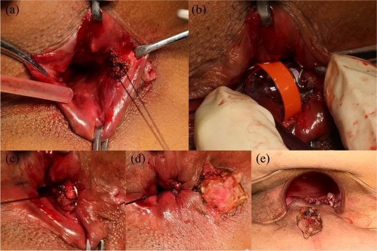 This composite of clinical photographs illustrates the intraoperative stages of treating a cryptoglandular fistula-in-ano using an Anal Fistula Clip (AFC) and an endorectal advancement flap (ERAF). (a) Preparation of the internal opening at the dentate line with the placement of two U-shaped traction sutures. (b) Advancement of the specialized AFC applicator into the anal canal, featuring a distinct orange band for visualization. (c) Deployment and release of the nitinol super-elastic clip at the internal opening to achieve mechanical closure. (d) Debridement and appropriate excision of the external fistula tract to facilitate adequate drainage and tissue healing. (e) Final view showing the sutured endorectal advancement flap (ERAF), providing a multi-layered closure of the anorectal defect. The series demonstrates a sphincter-preserving surgical technique aimed at managing complex perianal fistulous disease while minimizing the risk of incontinence.