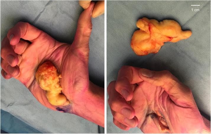 A composite clinical photograph showing the surgical excision of a giant lipoma from the palm of a human hand. The left panel demonstrates the excised specimen placed over the volar surface of the palm for size comparison, illustrating its substantial dimensions (4.8 x 1.8 x 8.6 cm). The right panel displays the macro specimen separately and the post-excision surgical site. The lipoma is a large, multi-lobulated, yellowish-tan mass with a glistening, encapsulated surface and focal areas of reddish hypervascularity. The surgical site involves the palmar region near the carpal tunnel and Guyon's canal, showing an open longitudinal incision with some exposed soft tissue and skin erythema. A 1 cm scale bar is present in the top right. This image illustrates the surgical management of a deep-seated hand lipoma causing compressive neuropathies of the median and ulnar nerves.