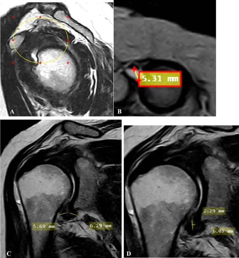 A multi-panel MRI study of the shoulder demonstrating radiological signs of adhesive capsulitis (frozen shoulder). Image A (oblique sagittal T2-weighted) shows the complete obliteration of the subcoracoid fat triangle within the rotator interval (encircled). Image B (oblique axial fat-suppressed PD-weighted) identifies a significant effusion (5.31 mm) within the long head of the biceps tendon sheath, exceeding the normal threshold. Images C and D (oblique coronal T2-weighted) focus on the axillary recess. Image C measures the pathological thickening of the joint capsule at the humeral (5.69 mm) and glenoid (6.29 mm) aspects. Image D provides measurements for the maximal height (2.29 mm) and width (6.03 mm) of the axillary recess space. This composite image illustrates key diagnostic criteria including rotator interval fat replacement, synovial effusion, and capsular thickening, which are critical for the radiological staging of adhesive capsulitis in a clinical setting.