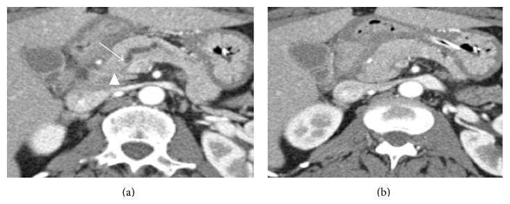 Two-panel contrast-enhanced axial CT scan of the abdomen focused on the pancreatic head during the pancreatic phase. Image (a) demonstrates a markedly dilated pancreatic duct with an abrupt termination in the pancreatic head (marked by an arrow), a classic indirect sign of an obstructing lesion. Despite the ductal obstruction, no discrete hypoattenuating mass is clearly visualized at the point of termination (arrowhead). Image (b), taken 1 cm inferiorly, shows the pancreatic head exhibiting homogeneous enhancement and normal morphology, lacking typical signs of malignancy such as mass effect or hypoattenuation. This visual represents a 'CT-isoattenuating' pancreatic ductal adenocarcinoma, where the tumor's density matches the surrounding parenchyma, making it occult on standard imaging despite its significant size (3.9 cm). This educational case highlights the importance of recognizing secondary imaging signs like pancreatic ductal dilation and abrupt 'cut-off' when a primary mass is not visible.