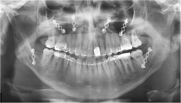 This panoramic dental radiograph (orthopantomogram) displays the postoperative status of a patient following bimaxillary orthognathic surgery. The image shows the complete maxillary and mandibular arches with comprehensive fixed orthodontic appliances (braces) consisting of brackets and continuous archwires. Radiopaque surgical hardware is prominent: four titanium miniplates are secured with monocortical screws across the maxillary Le Fort I osteotomy site along the zygomaticomaxillary and nasomaxillary buttresses. In the mandible, bilateral miniplates and screws are visible at the ramus-body junction, indicating fixation following a bilateral sagittal split osteotomy (BSSO). The anatomical landmarks, including the maxillary sinuses, nasal cavity, and mandibular condyles, are well-visualized. The hardware orientation demonstrates rigid internal fixation designed to stabilize the skeletal segments during bone healing. This image is an educational example of postoperative imaging in oral and maxillofacial surgery for the correction of dentofacial deformities like facial asymmetry and malocclusion.