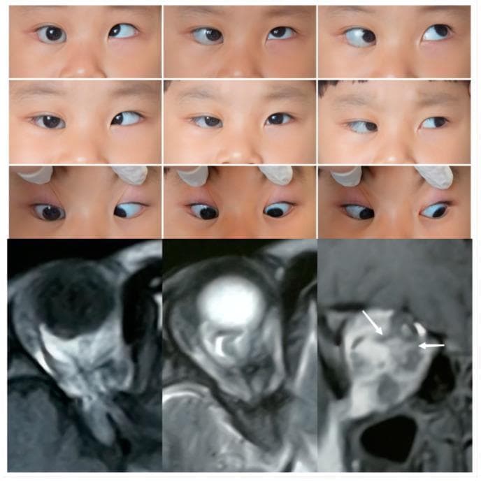 Educational composite image illustrating Case 2 of supernumerary extraocular muscles (SEOM). The upper panel consists of nine clinical gaze photographs of a pediatric patient, demonstrating a large-angle right esotropia (approx. 30 prism diopters) and a severe abduction limitation (-4) of the right eye. The primary position and multiple directions of gaze show restrictive motility, along with eyelid entropion and an enlarged palpebral aperture in the right eye. The bottom panel displays diagnostic MRI scans, including T1 axial, T2 axial, and T2 coronal sections. These images reveal anatomical abnormalities in the right orbit, characterized by anomalous extraocular muscle (EOM) bands that extend from the orbital apex and connect multiple rectus muscles (SR, IR, LR, and MR). White arrows on the coronal section highlight these atypical muscular connections. Additionally, the right optic nerve is shown to be maldeveloped (hypoplastic) with an indistinct course, representing a Type 2 SEOM classification where anomalous tissue surrounds the optic nerve and disrupts normal ocular motility.