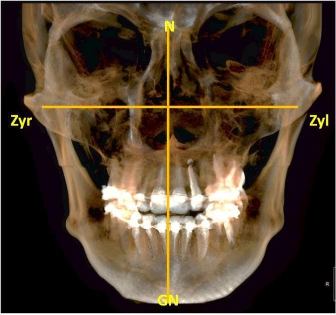 This diagnostic image is a 3D-reconstructed panfacial Cone Beam Computed Tomography (CBCT) scan showcasing the human facial skeleton in an anterior-posterior view. The semi-transparent volumetric rendering allows for the visualization of deep skeletal structures, including the maxilla, mandible, nasal cavity, and orbits. Superimposed on the anatomy are anthropometric measurements used to calculate the facial index. A vertical reference line is marked from the nasion (labeled 'N') to the gnathion (labeled 'GN'), representing morphological facial height. A horizontal reference line spans between the right zygion (labeled 'Zyr') and left zygion (labeled 'Zyl'), representing the bizygomatic breadth. The dentition is visible within the alveolar processes of the jaws, with some high-density areas suggesting dental restorations or artifacts. This image serves as an educational tool for dental and maxillofacial radiology, specifically demonstrating the application of craniofacial landmarks in anthropometric analysis and cephalometric classification (e.g., leptoprosopic or euryprosopic facial types).