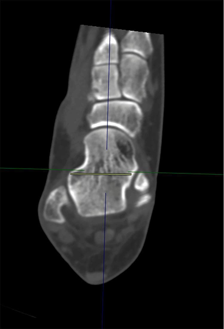 This diagnostic image is an axial computed tomography (CT) scan slice of the human foot, specifically focused on the talus for orthopedic morphometric analysis. The image demonstrates the methodology for measuring Talar Neck Width (TNW). The anatomy shown includes the talar body, the constricted talar neck, and the talar head, with surrounding midfoot structures and the calcaneus partially visible. A yellow horizontal measurement line is placed across the talar neck, extending from the medial border to the lateral border. This measurement is oriented orthogonally to the anatomical longitudinal axis of the talar neck (represented by a blue vertical reference line). A green horizontal reference line intersects the measurement plane to ensure anatomical alignment. This clinical imaging protocol is used in podiatry and orthopedic surgery for preoperative planning, fracture management (such as talar neck fractures), and anatomical studies of foot morphology.
