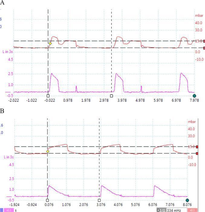 A comparison chart consisting of two sets of mechanical ventilation waveforms (pressure-time and flow-time curves) demonstrating different control variables. The upper panel (Ventilator 1) shows characteristics of volume-controlled ventilation, where the pressure curve (red) reaches a peak and then maintains a plateau, while the flow curve (purple) rises instantaneously and remains constant before falling, indicating a square flow waveform. The lower panel (Ventilator 2) illustrates pressure-controlled ventilation. In this mode, the pressure curve (red) rapidly rises to a set level (approximately 15 mbar) and maintains a plateau, while the flow curve (purple) shows a peak followed by a decelerating ramp pattern. Both panels show three respiratory cycles over an approximately 8-second window, with vertical dashed lines marking the start of inspiration. These waveforms are critical for respiratory therapy education to distinguish between volume-preset and pressure-preset mechanical ventilation strategies.